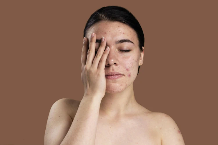 Comparing Different Types of Lasers for Acne Scar Treatment